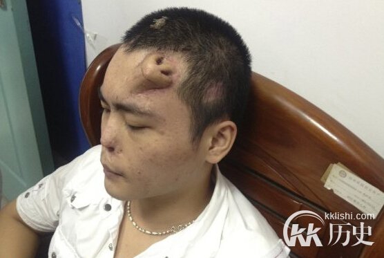 胆小勿看!实拍男子整容成狗头全程